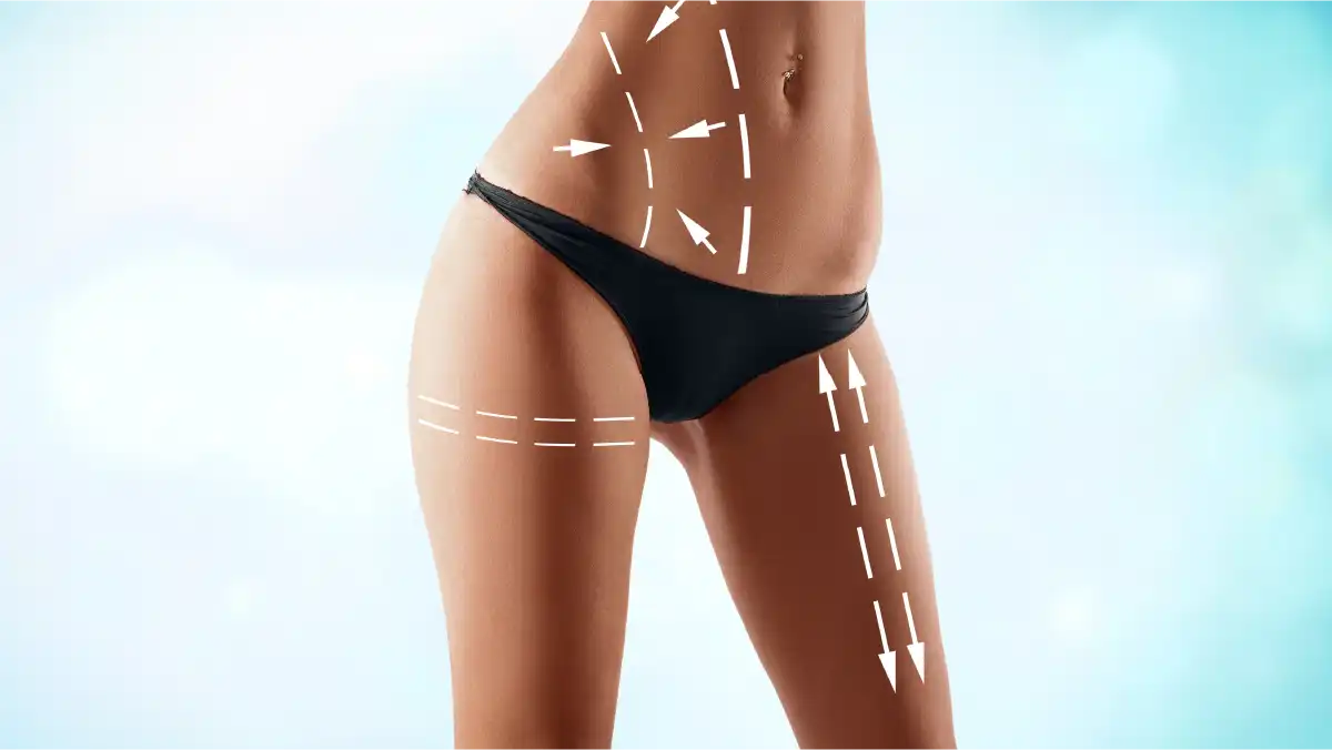 Your suitability for Liposuction